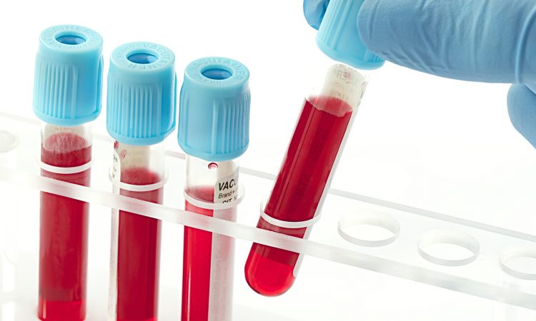 Δύο νέες εξετάσεις αίματος εντοπίζουν γρήγορα το μεταστατικό μελάνωμα
